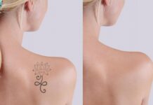 Tips For Finding A Tattoo Removal Expert Tattoo Removal