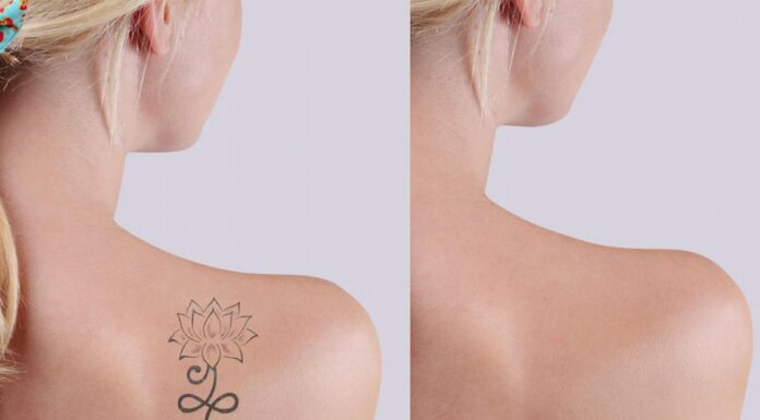 Tips For Finding A Tattoo Removal Expert Tattoo Removal