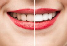 Your Guide To Wedding Smile Makeovers Smile Makeovers