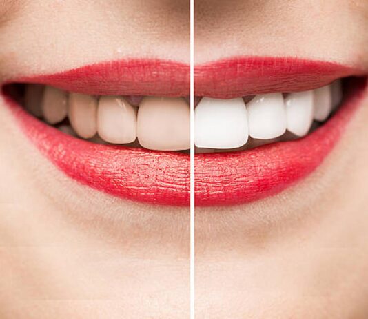 Your Guide To Wedding Smile Makeovers Smile Makeovers