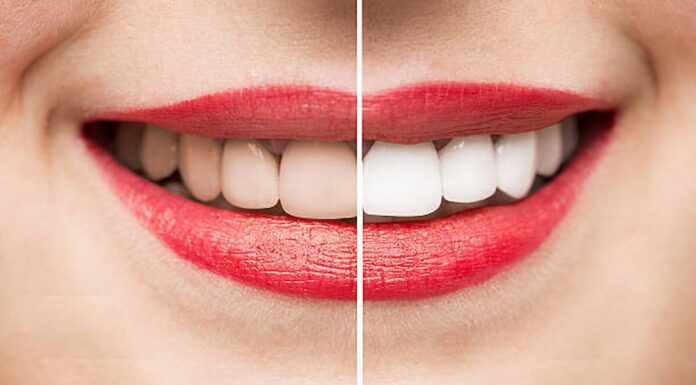 Your Guide To Wedding Smile Makeovers Smile Makeovers