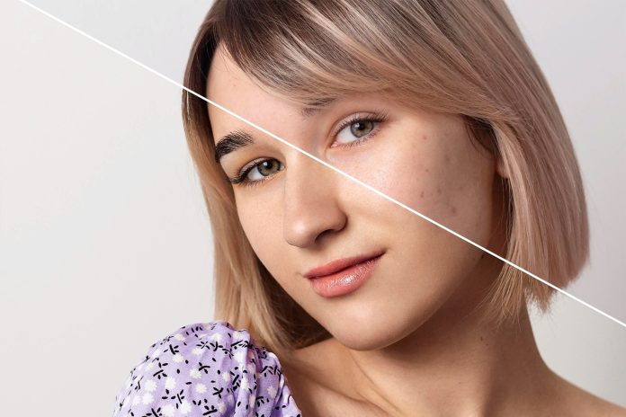 Skin Rejuvenation