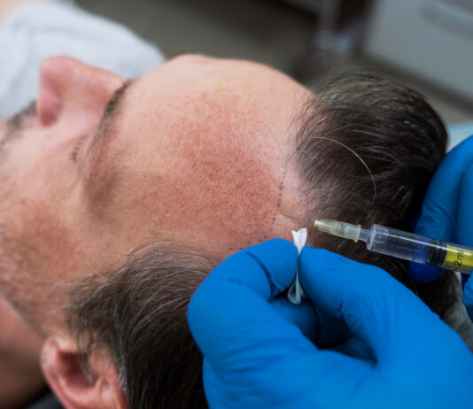 PRP vs Hair Transplant: Which Treatment Is Right for You? PRP vs Hair Transplant