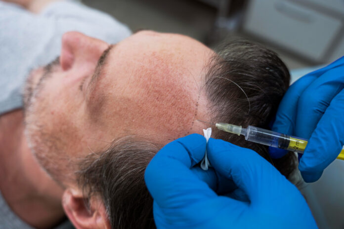 PRP vs Hair Transplant Which Treatment Is Right for You PRP vs Hair Transplant